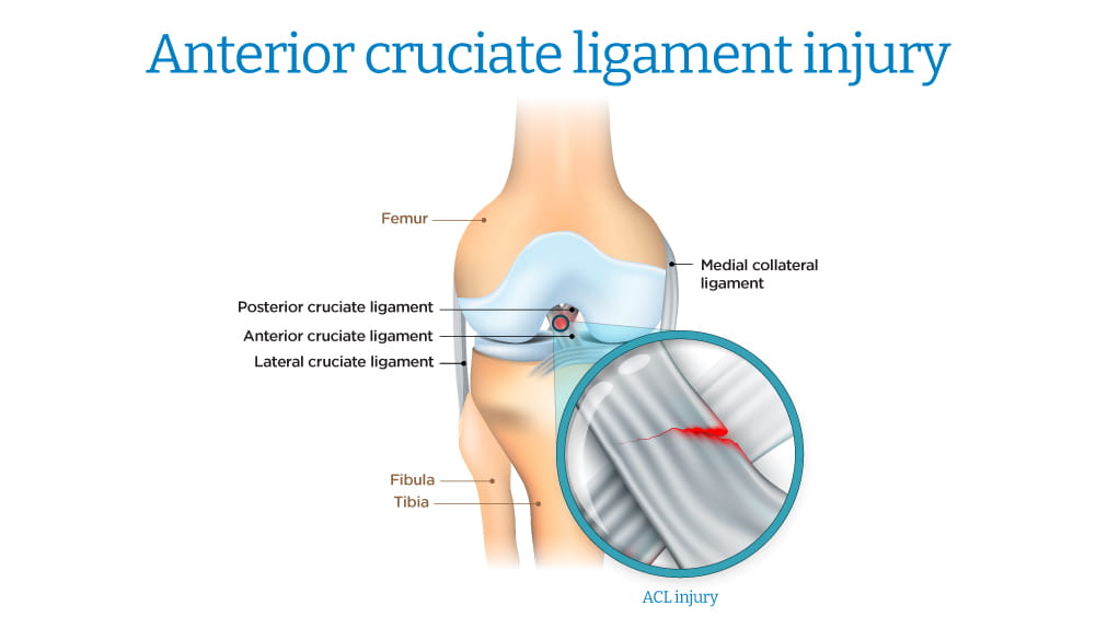 Anterior Cruciate Ligament (ACL) Tear
