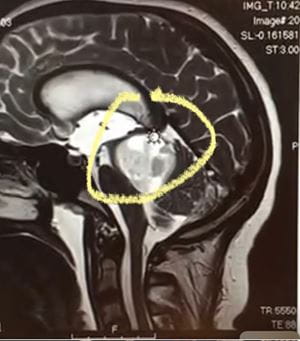 A brain scan showing Reagan's tumor