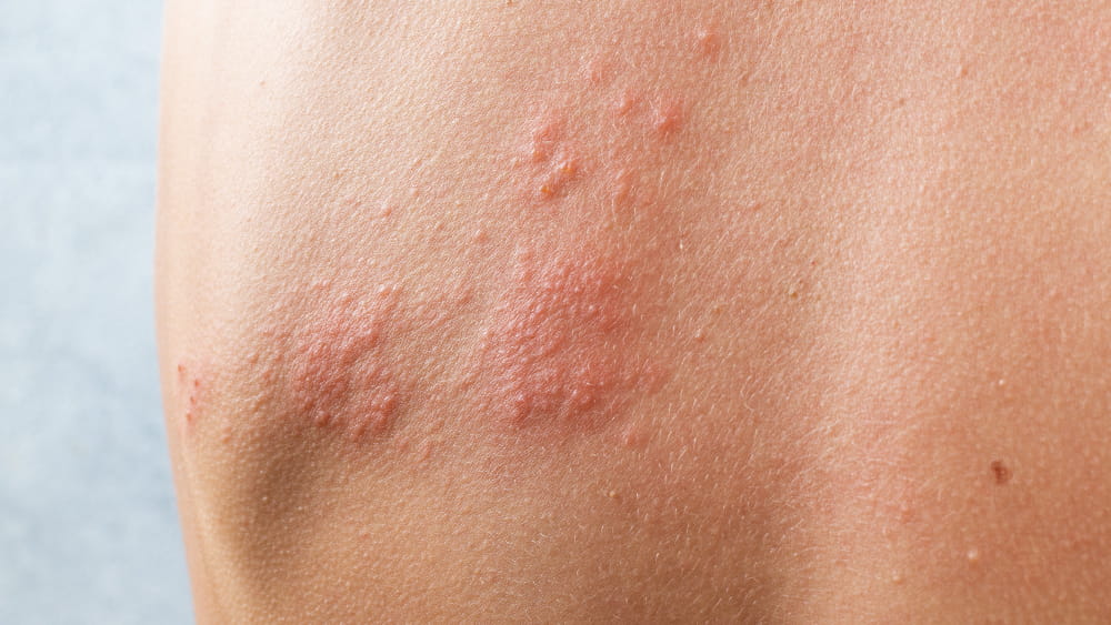 Example of shingles rash