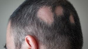 A white man with alopecia areata has circular patches of missing hair on the back of his head