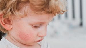 A young white child with a red rash on his cheek