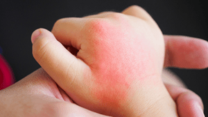 Baby hand with rash