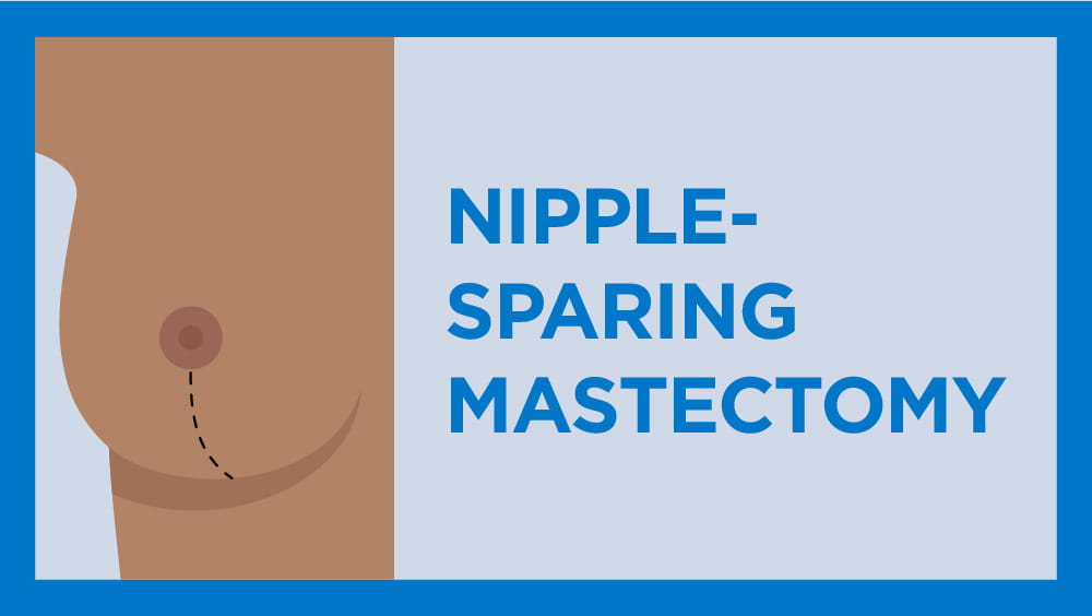 medical illustration depicting a nipple sparing mastectomy on brown skin