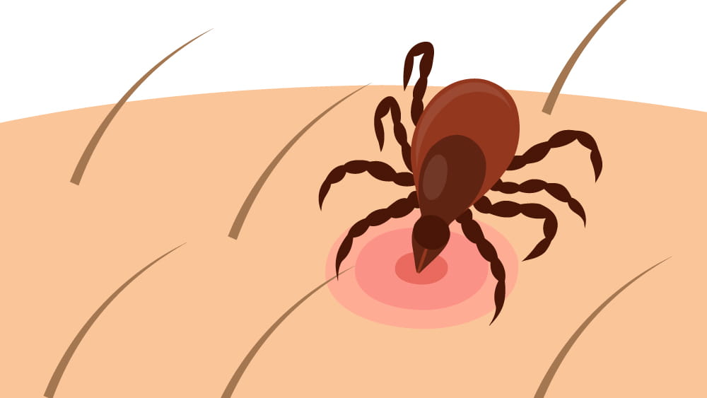 Illustration of a tick on human skin