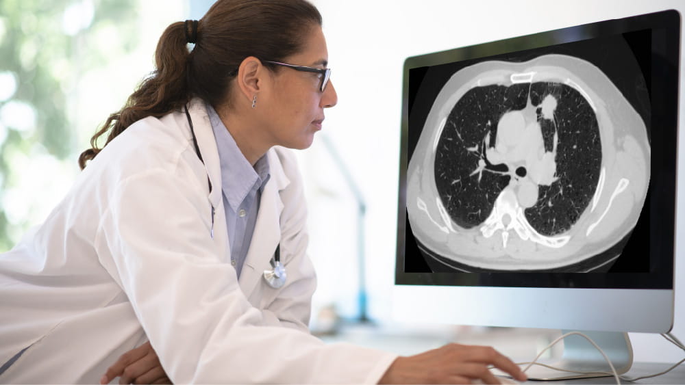 Lung cancer screening program